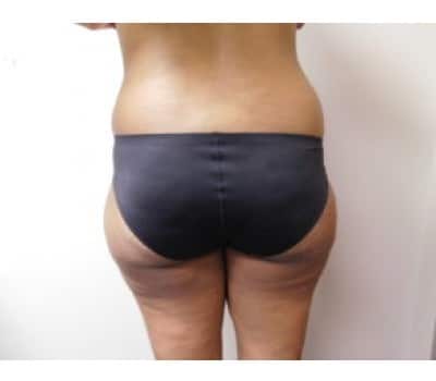 Before Image: Liposuction - back