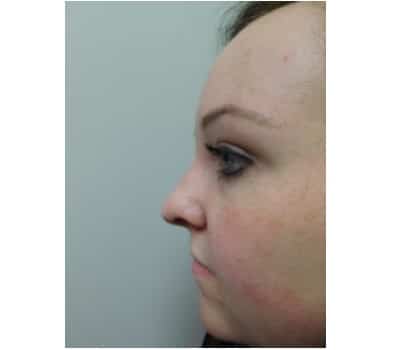 After Image: Rhinoplasty - other