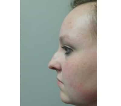 Before Image: Rhinoplasty - other