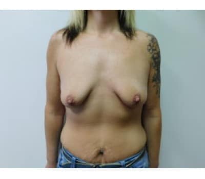 Before Image: Breast Augmentation with Lift - front