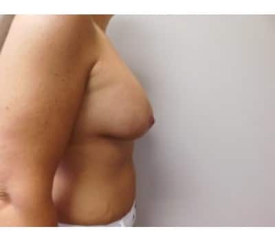 After Image: Breast Augmentation with Lift - other