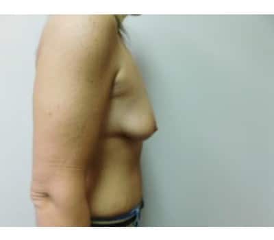 Before Image: Breast Augmentation with Lift - other