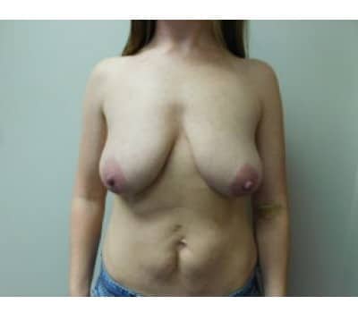 Before Image: Breast Augmentation with Lift - front