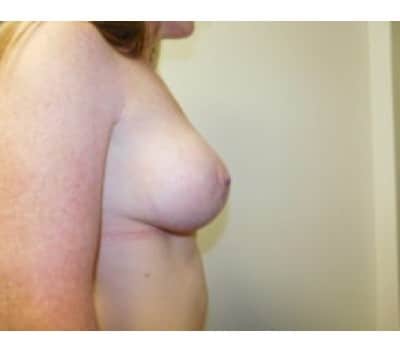 After Image: Breast Augmentation with Lift - other