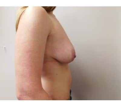 Before Image: Breast Augmentation with Lift - other
