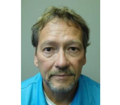After Image: Otoplasty - front