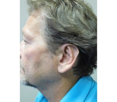 After Image: Otoplasty - other