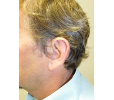 Before Image: Otoplasty - other