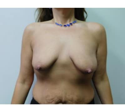 Before Image: Breast Augmentation with Lift - front