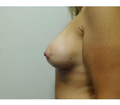 After Image: Breast Augmentation with Lift - left-side