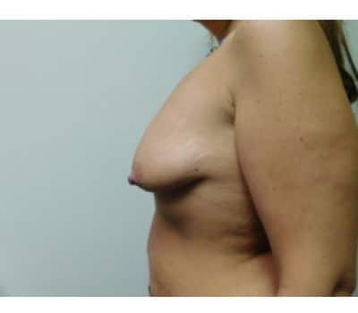 Before Image: Breast Augmentation with Lift - left-side