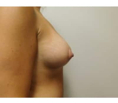After Image: Breast Augmentation with Lift - right-side