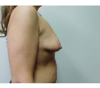 Before Image: Breast Augmentation with Lift - right-side