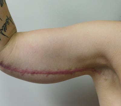 After Image: Brachioplasty - front