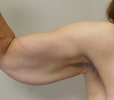 Before Image: Brachioplasty - front