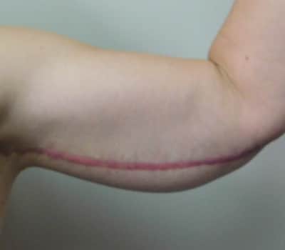 After Image: Brachioplasty - front