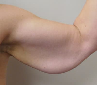 Before Image: Brachioplasty - front