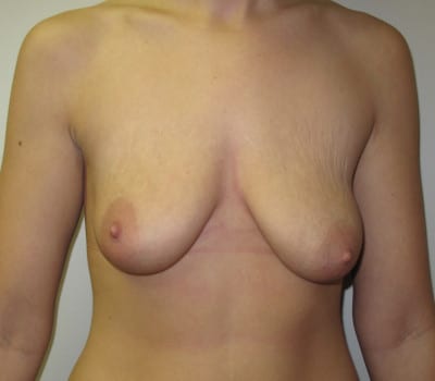 Before Image: Augmentation Mastopexy - front