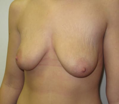 Before Image: Augmentation Mastopexy - left-side