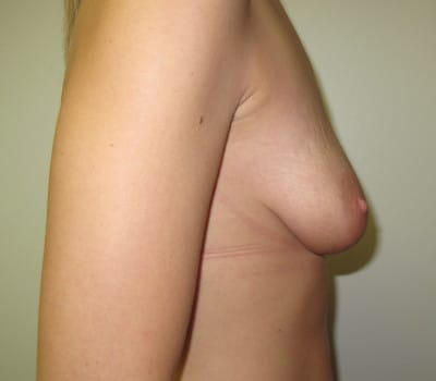 Before Image: Augmentation Mastopexy - other