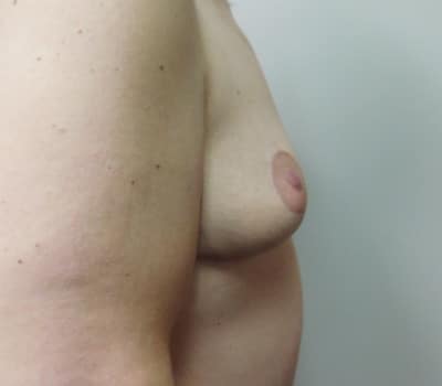 Before Image: Augmentation and Mastopexy - other