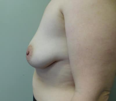 Before Image: Augmentation Mastopexy - other