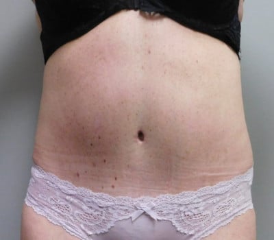 After Image: Abdominoplasty - front