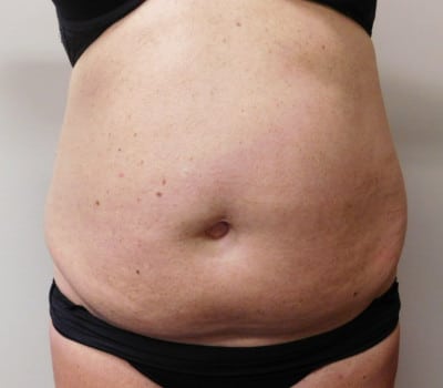 Before Image: Abdominoplasty - front