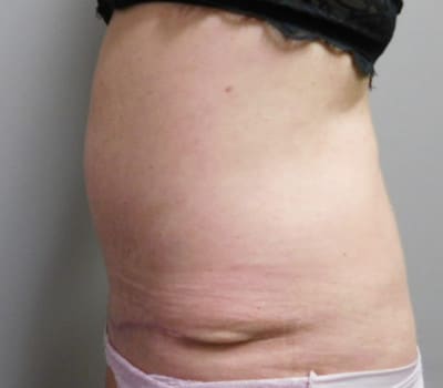 After Image: Abdominoplasty - other