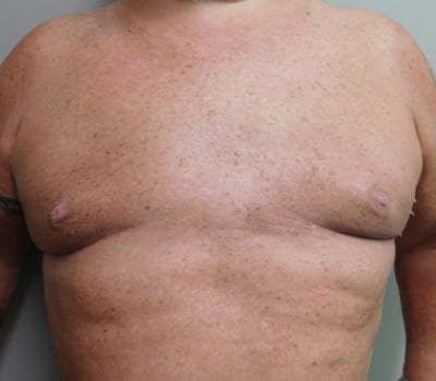 After Image: Liposuction - front