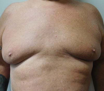 Before Image: Liposuction - front