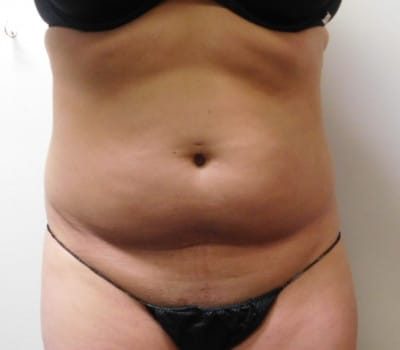 Before Image: Liposuction - front