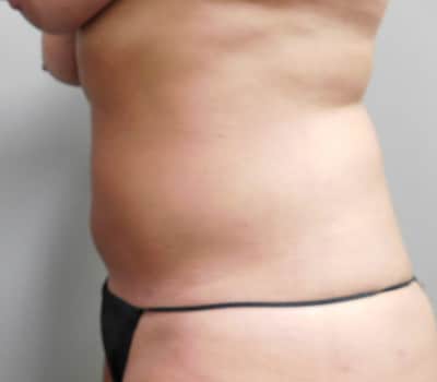 After Image: Liposuction - other