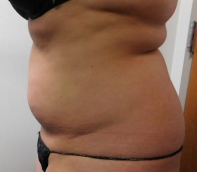 Before Image: Liposuction - other