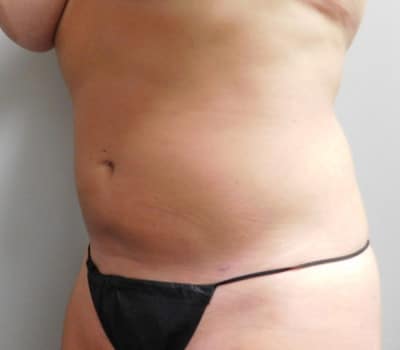 After Image: Liposuction - left-side