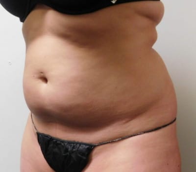 Before Image: Liposuction - left-side