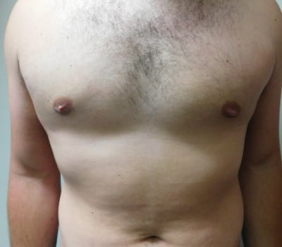 After Image: Gynecomastia - front
