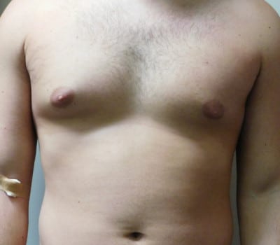 Before Image: Gynecomastia - front
