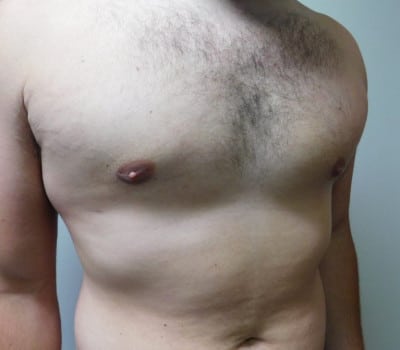 After Image: Gynecomastia - other
