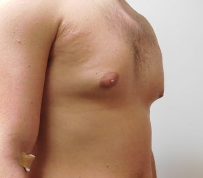 Before Image: Gynecomastia - other