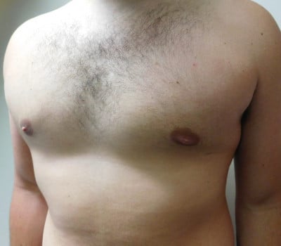 After Image: Gynecomastia - left-side