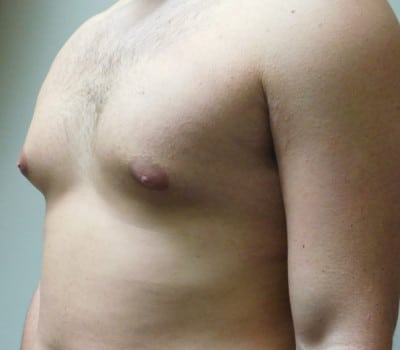 Before Image: Gynecomastia - left-side
