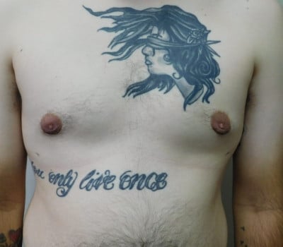 After Image: Gynecomastia - front