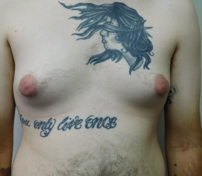 Before Image: Gynecomastia - front