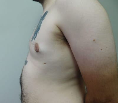 After Image: Gynecomastia - other