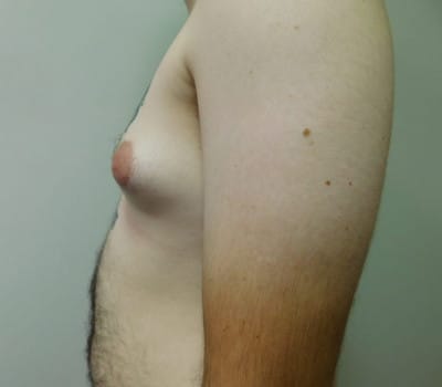Before Image: Gynecomastia - other