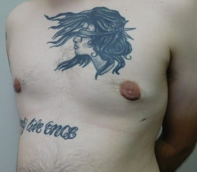 After Image: Gynecomastia - left-side