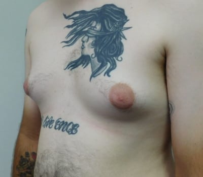 Before Image: Gynecomastia - left-side