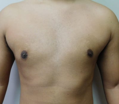 After Image: Gynecomastia - front