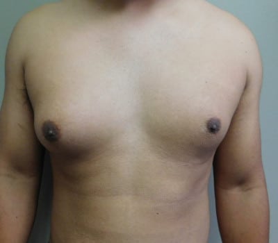 Before Image: Gynecomastia - front